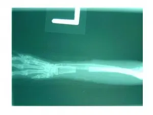 X-ray of rabbit ulna osteotomy healing